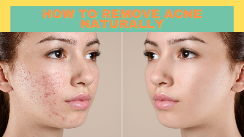 HOW TO REMOVE ACNE NATURALLY